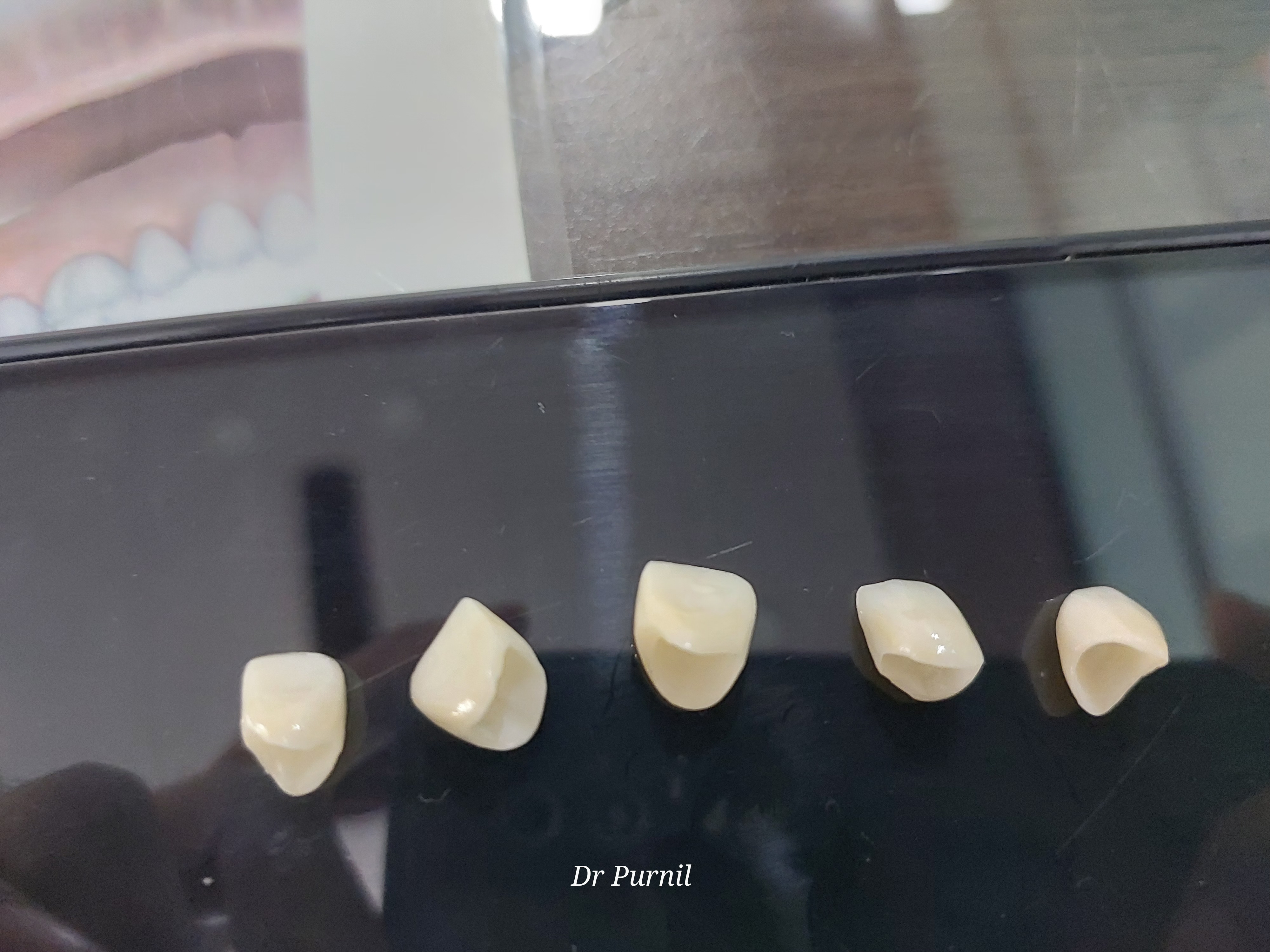 Smile Transformation 1