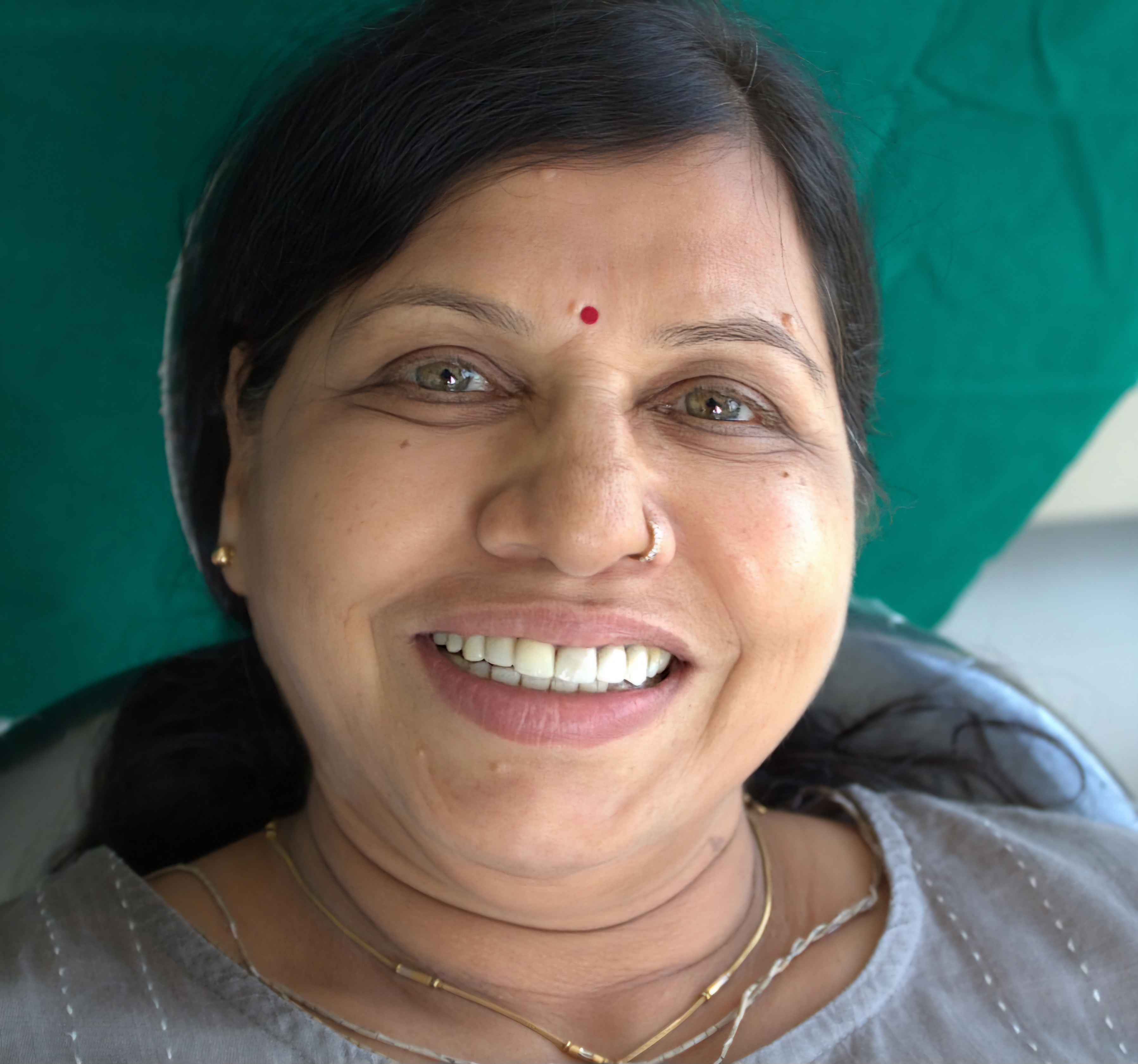 Smile Transformation 4