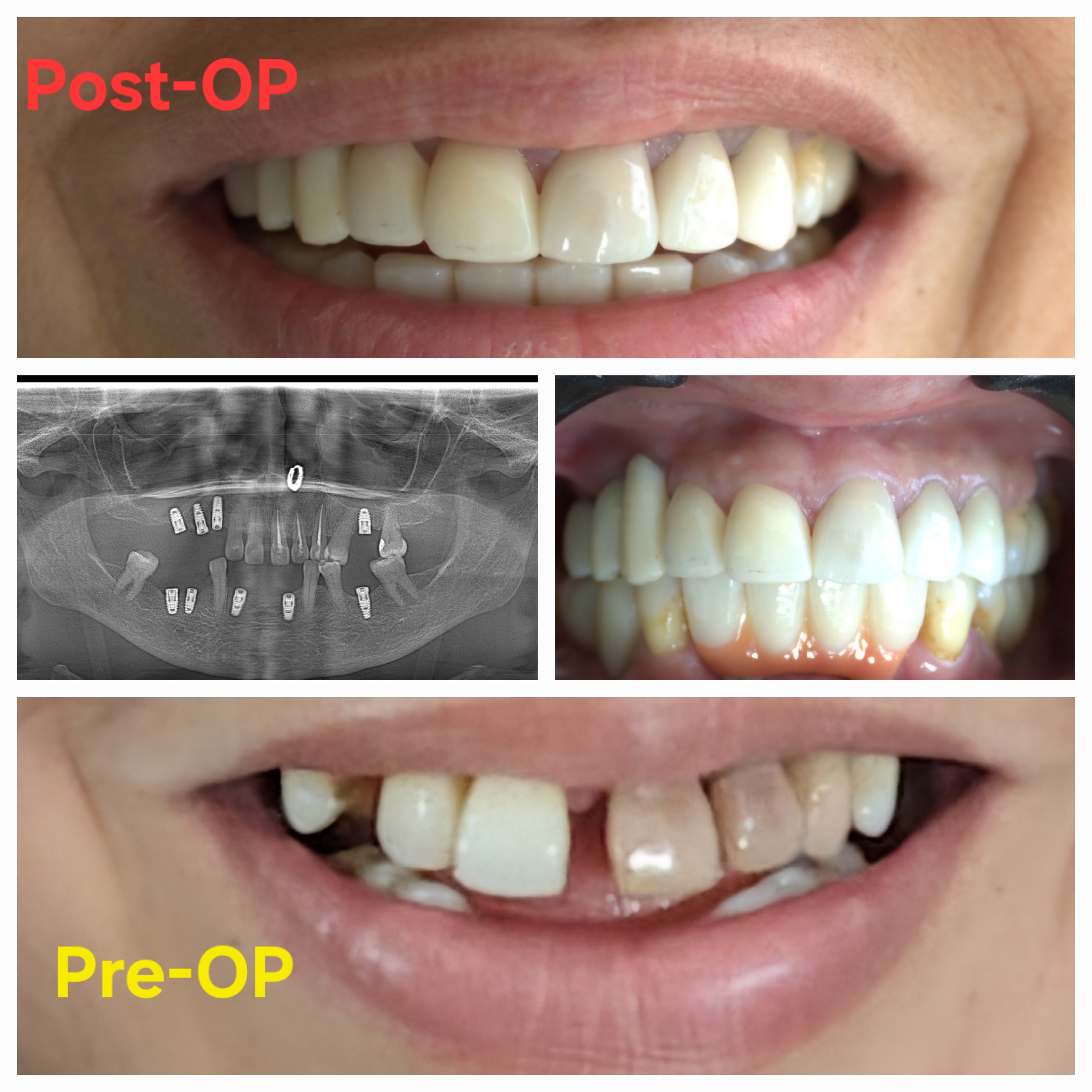 Smile Transformation 5